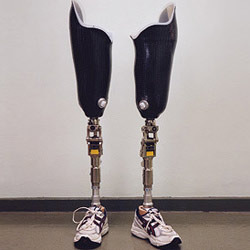 Above Knee Prosthesis