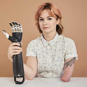 Below-Elbow Touch Bionics