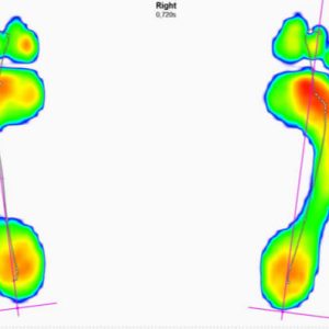 3D Print Custom Made Insole